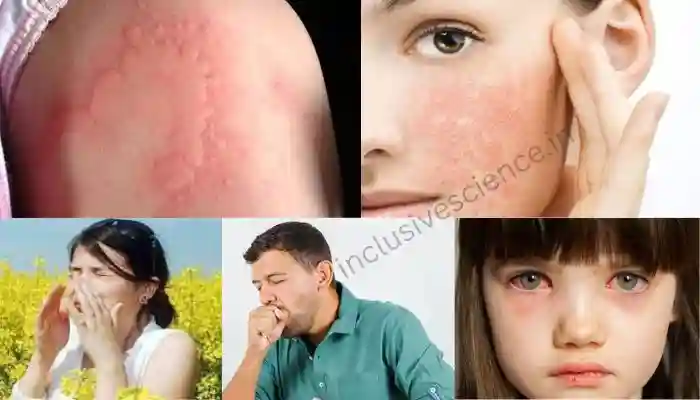 allergy ke lakshan, एलर्जी क्या है?